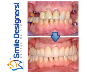 bridge-sur-implants-dentaires-ref1